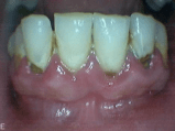 Gingivitis and Decay